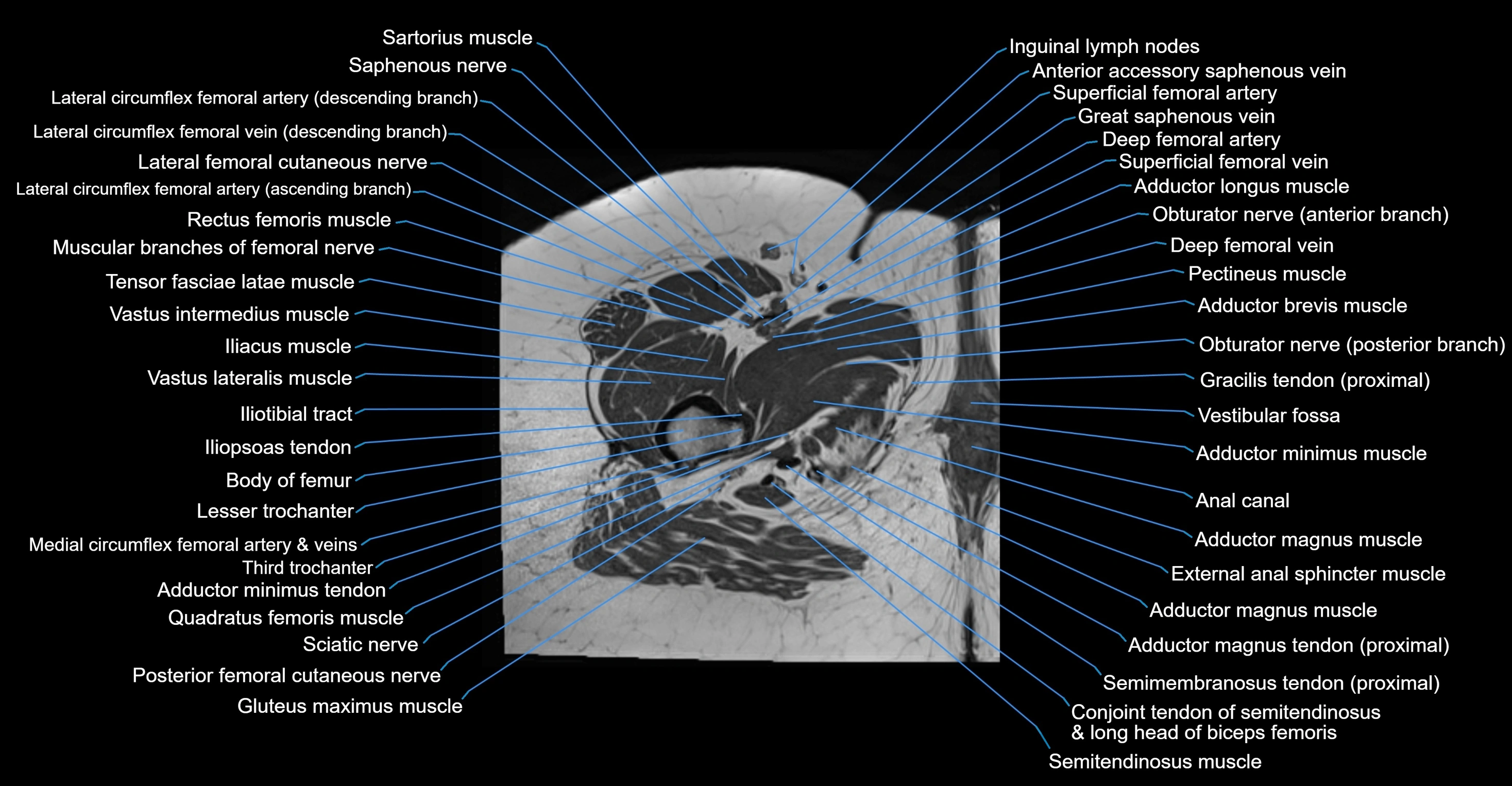 MRI hip axial cross sectional anatomy 3T 3D  radiology  anatomy image-img-00001-00071.webp